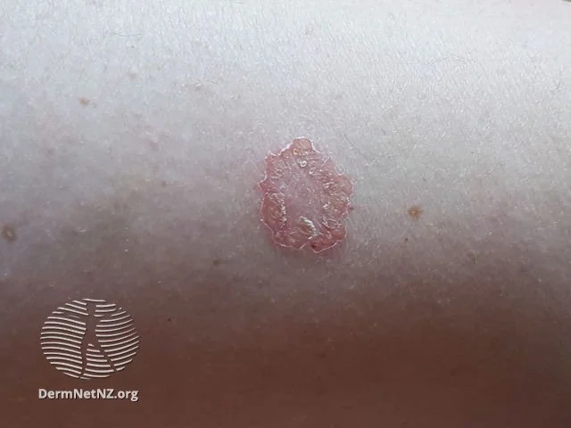 Forma Numular Eczema Nummular Eczema Vs Ringworm Pictures